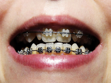 Zahnspange offener Mund